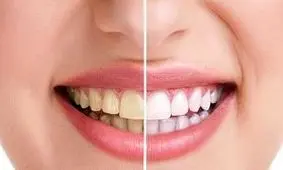 برای داشتن دندانی زیبا از این خوراکی‌ها دور شوید