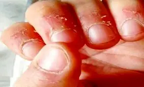 چرا ناخن می جویم؟