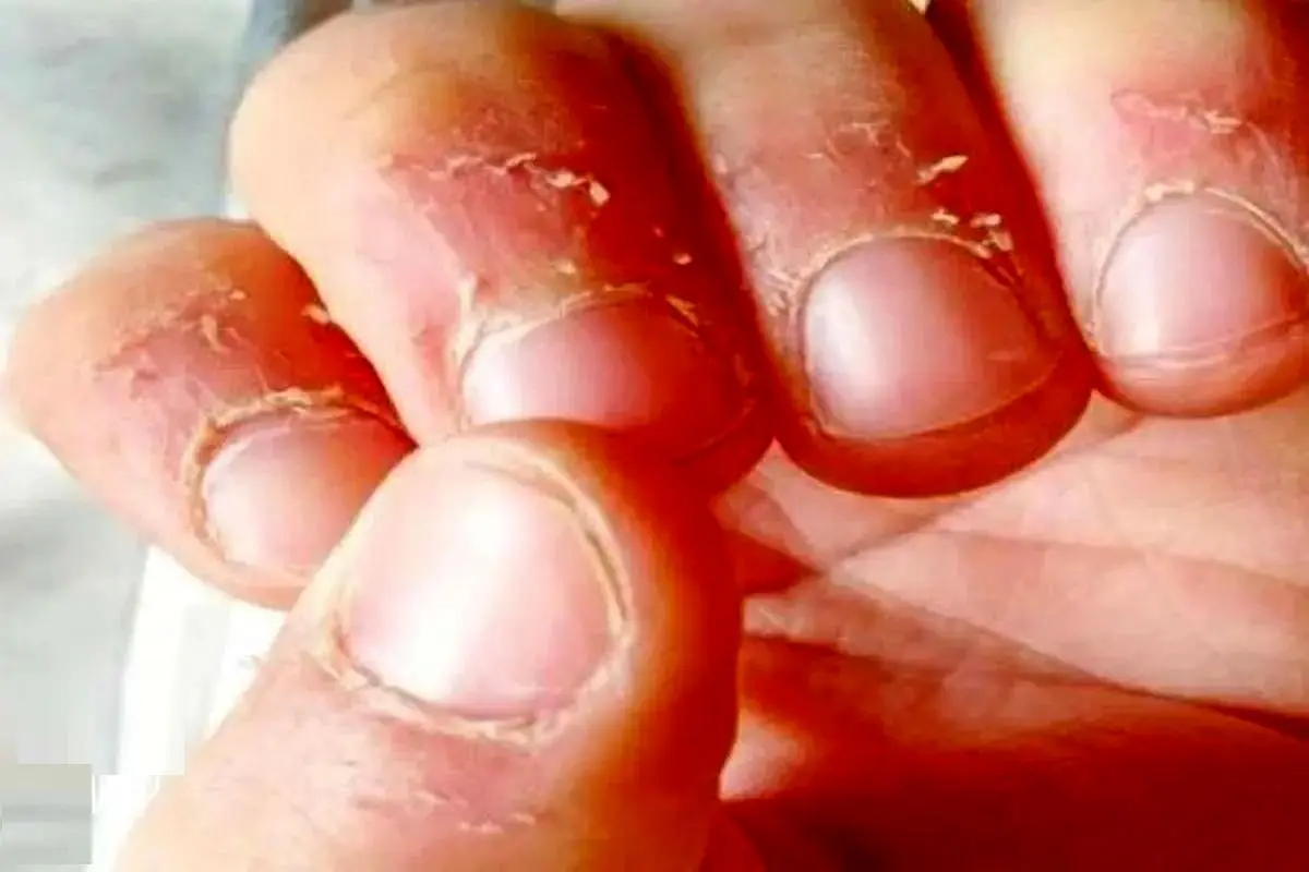 چرا ناخن می جویم؟