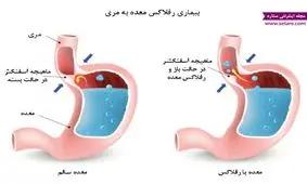 برای درمان رفلاکس عرق نعنا نخورید