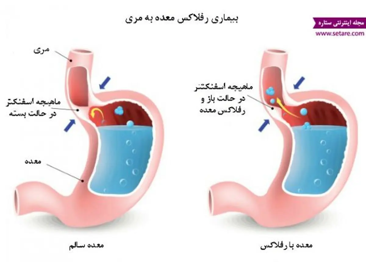 برای درمان رفلاکس عرق نعنا نخورید