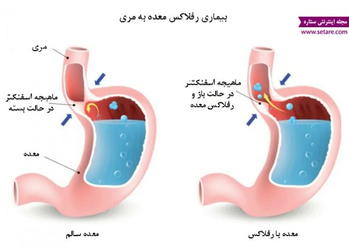 برای درمان رفلاکس عرق نعنا نخورید