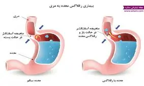 برای درمان رفلاکس عرق نعنا نخورید