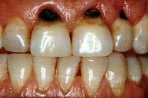 چه نوشیدنی هایی دندان ها را از بین می برند؟