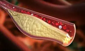۱۰ نشانه شگفت انگیز کلسترول بالا را جدی بگیرید
