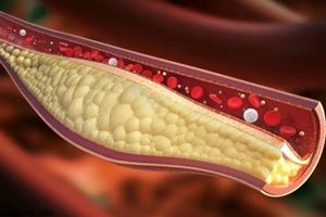 ۱۰ نشانه شگفت انگیز کلسترول بالا را جدی بگیرید