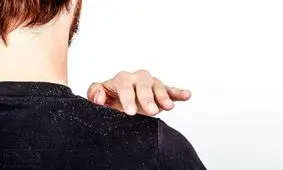 5 عامل اصلی شوره سر