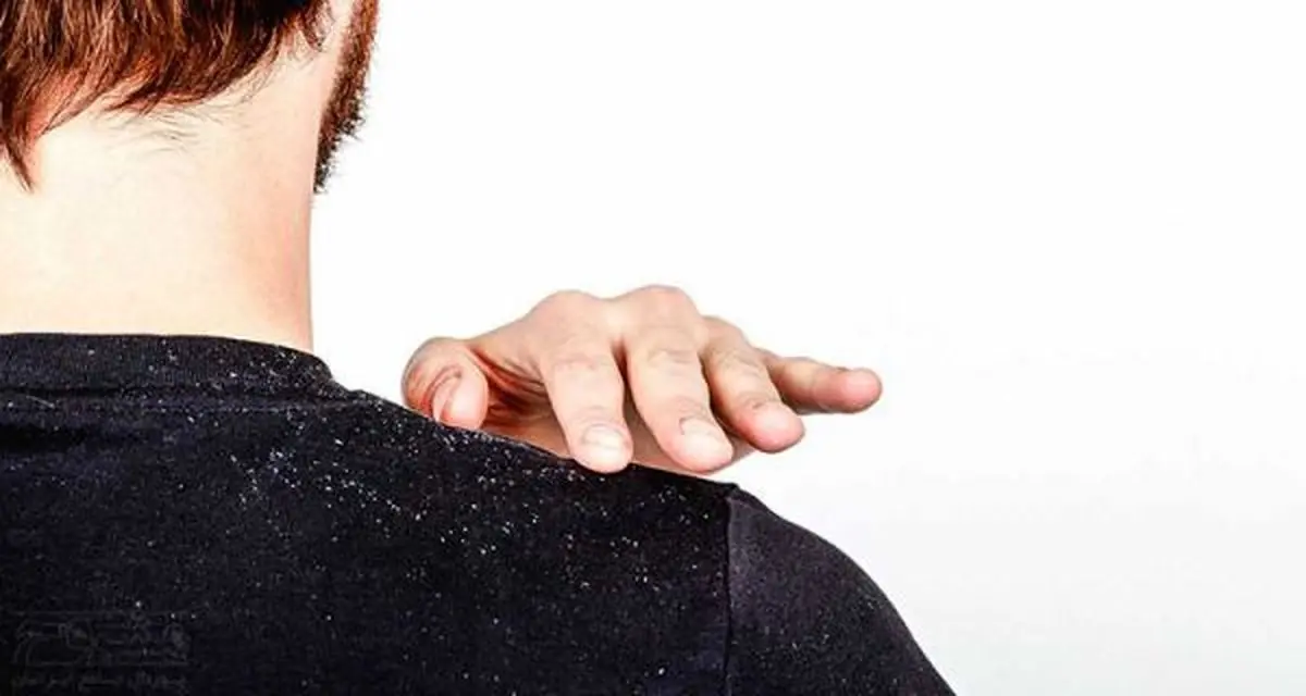 5 عامل اصلی شوره سر