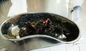 خارج کردن یک کیلو چوب و پلاستیک از شکم یک نوجوان هندی