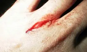 روش های جالب خانگی برای جلوگیری از خونریزی