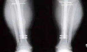 عمل جراحی برای افزایش قد توصیه می شود؟