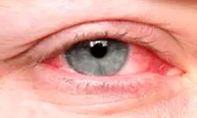 راهکارهای مقابله با خشکی چشم در آلودگی هوا