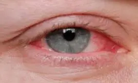 راهکارهای مقابله با خشکی چشم در آلودگی هوا