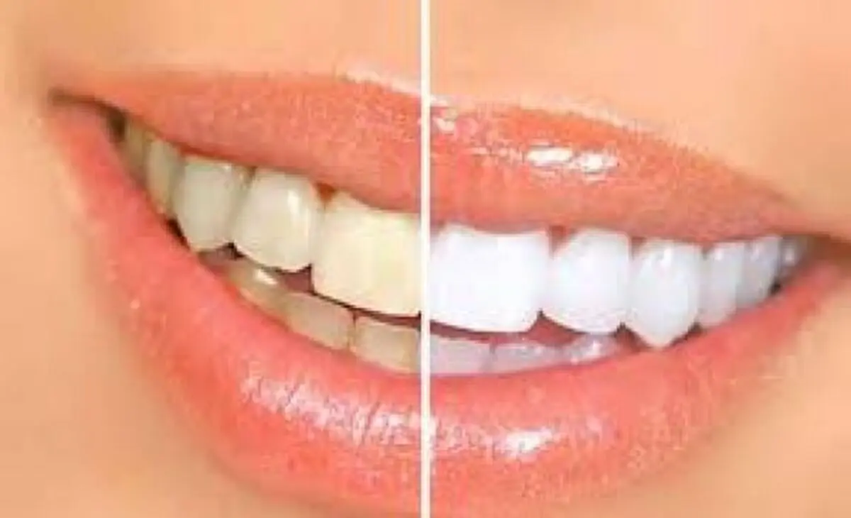 راه های جلوگیری از زردی دندان ها