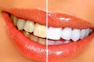 راه های جلوگیری از زردی دندان ها