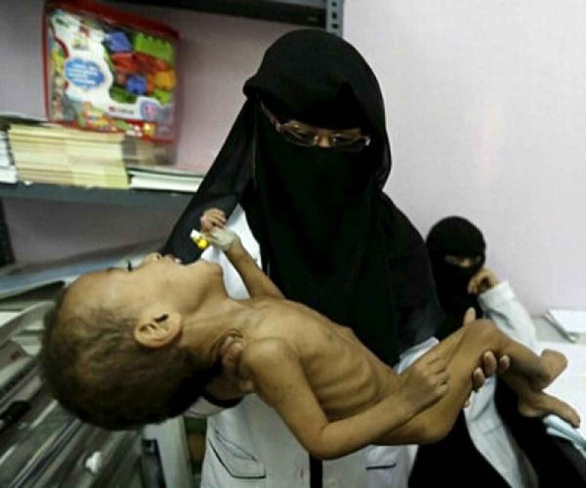 وضعیت وخیم کودکان در یمن/هر ۱۰ دقیقه یک کودک در یمن می‌میرد