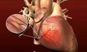 ۱۲ خوراکی که رگ‌های قلب را باز می‌کند