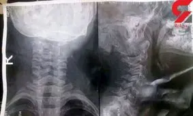 گیر کردن استخوان ماهی در گلوی کودک ۸ ساله گیلانی +عکس