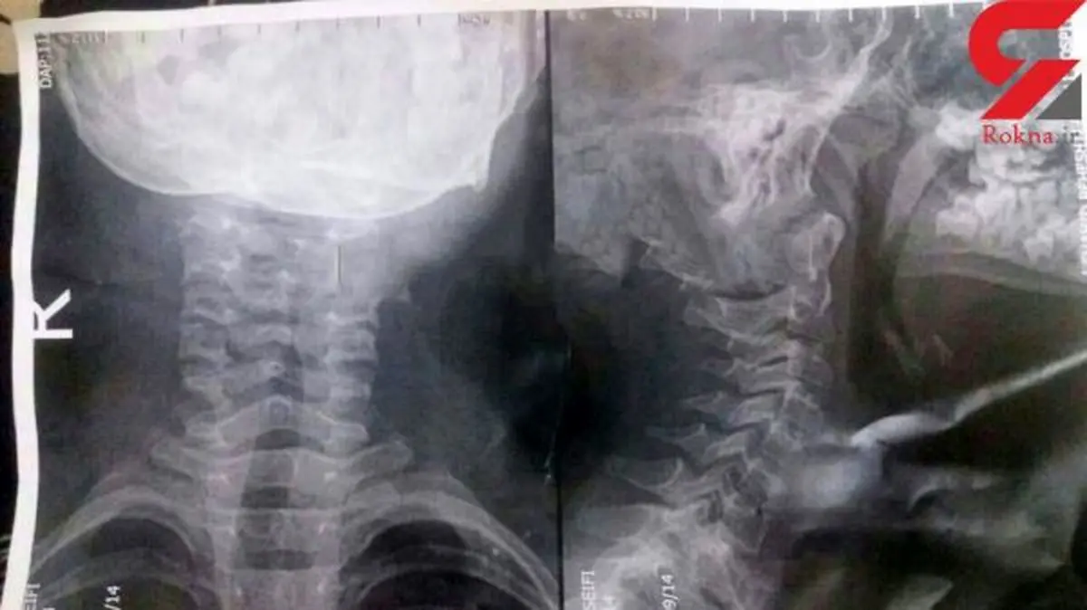 گیر کردن استخوان ماهی در گلوی کودک ۸ ساله گیلانی +عکس