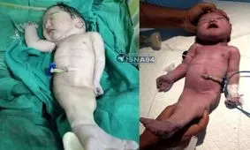 تولد کودکی به شکل پری دریایی