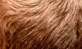 شپش سراغ چه کسانی می‌رود؟