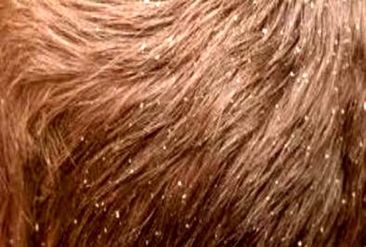 شپش سراغ چه کسانی میرود؟