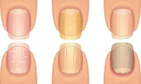 اینفوگرافیک / تشخیص بیماری از روی ناخن