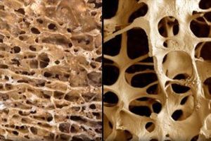 درمان پوکی استخوان با نانوذرات