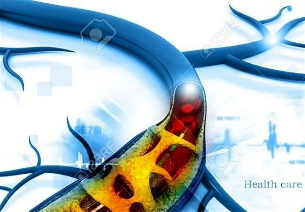 «انسداد» علت ایجاد غلظت خون، فشار خون، کبد چرب و واریس