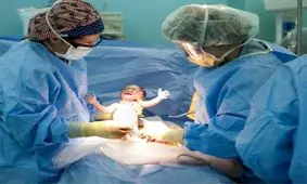 ایران پس از برزیل بالاترین میزان سزارین را در جهان دارد