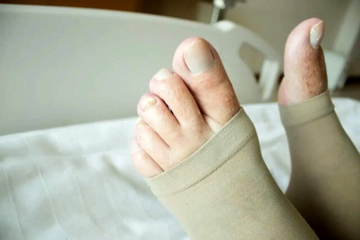 علائم لخته‌ خون در پا