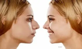 آشنایی با خطرات و عوارض عمل بینی