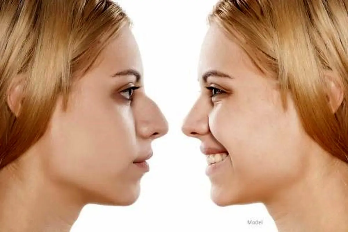 آشنایی با خطرات و عوارض عمل بینی