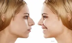 آشنایی با خطرات و عوارض عمل بینی