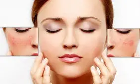 درمان‌های ساده برای رفع قرمزی پوست