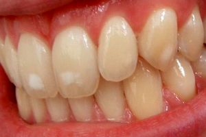 فلوروسیس، آسیب فلوراید به دندان
