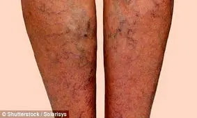 توصیه‌های تغذیه‌ای برای مبتلایان به واریس