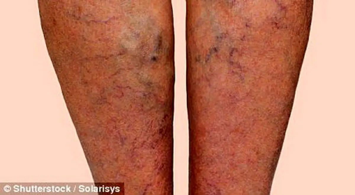 توصیه‌های تغذیه‌ای برای مبتلایان به واریس