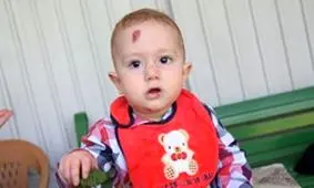 پانسمان پیشرفته برای بیماران «EB» تأمین می‌شود