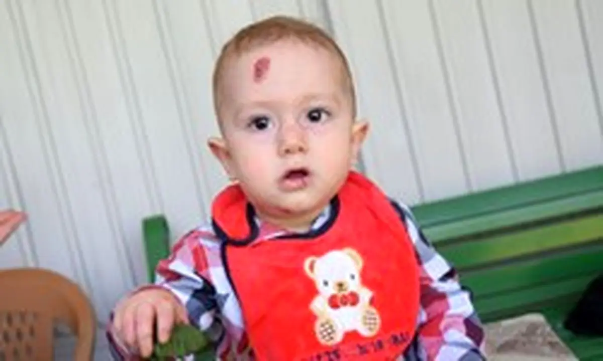 پانسمان پیشرفته برای بیماران «EB» تأمین می‌شود