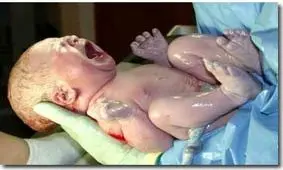 مقایسه ای بین سزارین و زایمان طبیعی