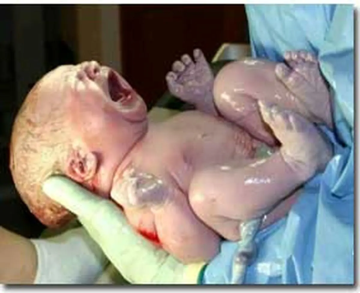 مقایسه ای بین سزارین و زایمان طبیعی