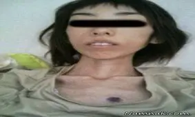 دختر جوانی که براثر شکنجه 16 کیلو شد!