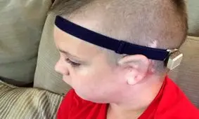 تاثیر «لوله گوش» در پیشگیری از عفونت گوش