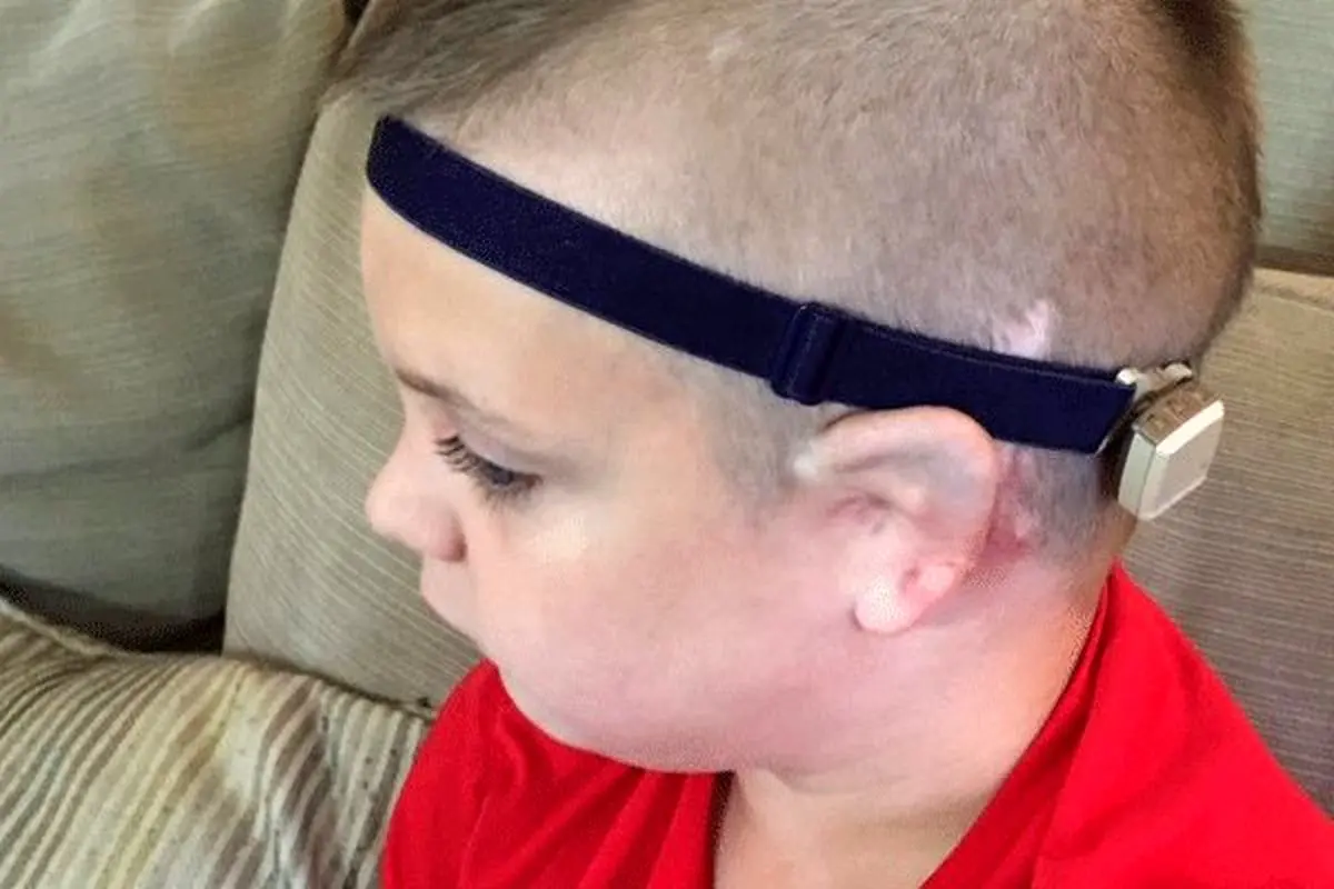 تاثیر «لوله گوش» در پیشگیری از عفونت گوش