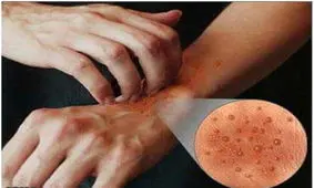 درمان اگزمای پوستی با یک روش غیرمعمول