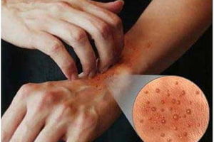 درمان اگزمای پوستی با یک روش غیرمعمول