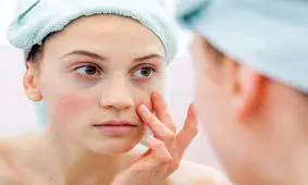 بیماری لوپوس چیست؟ + علت، علائم و راه های درمان