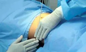 جراحی زیبایی شکم زنان، نکات مهم