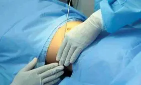 جراحی زیبایی شکم زنان، نکات مهم